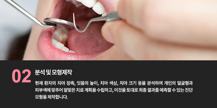 분석 및 모형제작
현재 환자의 치아 장축, 잇몸의 높이, 치아 색상, 치아 크기 등을 분석하여 개인의 얼굴형과 피부색에 맞추어 알맞은 치료 계획을 수립하고, 이것을 토대로 최종 결과를 예측할 수 있는 진단 모형을 제작합니다.