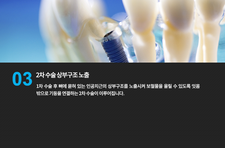 2차 수술 상부구조 노출
1차 수술 후 뼈에 묻혀 있는 인공치근의 상부구조를 노출시켜 보철물을 올릴 수 있도록 잇몸 밖으로 기둥을 연결하는 2차 수술이 이루어집니다.