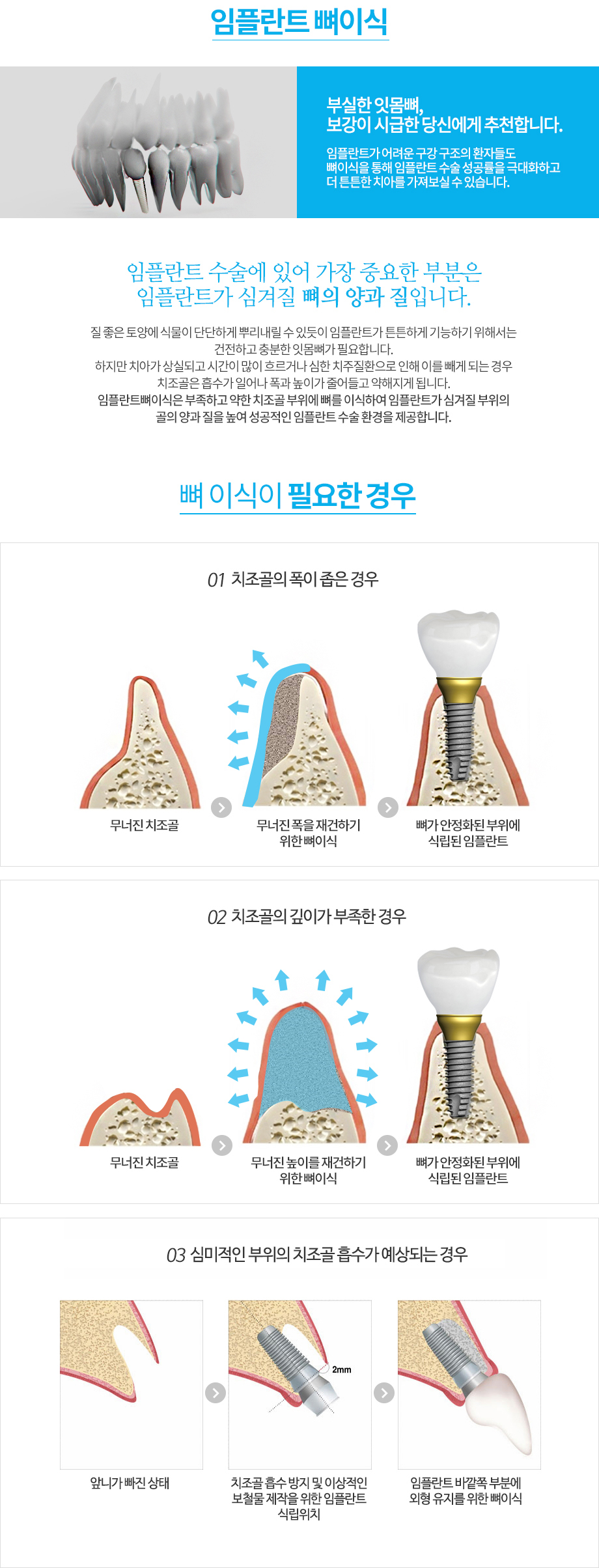 임플란트 장점
-자연치와 같은 저작력 회복
기존에 많이 사용하던 틀니나 브릿지에 비해 저작력에 있어 월등히 높은 자연치 회복력을 자랑하는 임플란트는 잇몸의 통증 없이 자연치아와 유사하게 음식의 맛과 온도, 질감 등을 느낄 수 있고, 잇몸 뼈를 유지시켜 주기 때문에 얼굴의 변형 없이 안정적인 회복이 가능합니다.
-잇몸뼈 보존
잇몸 속에서 치아를 받쳐 주는 역할을 하던 잇몸 뼈는 치아가 빠지게 되면서 오랫동안 방치하게 되면 할 일을 잃으면서 잇몸이 내려 앉는 경우가 많습니다. 이러한 자리에 임플란트를 식립함으로써 치아를 대신하여 임플란트와 잇몸 뼈가 유착되면서 잇몸 뼈가 보존될 수 있는 치료입니다.
-주변치아 손상 X
기존에는 치아가 탈락하게 되면 손쉽게 틀니나 브릿지의 방법을 사용하였는데요. 틀니는 다른 치아에 걸어서 사용하게 되므로 자연히 건강했던 치아에 무리를 줄 수 밖에 없고, 브릿지 역시 양 옆의 멀쩡한 자연치아를 갈아내어 시술하기 때문에 주변의 정상 치아들이 손상을 받게 됩니다. 그에 반해 임플란트는 손실된 자리 딱! 그 부위에만 식립이 이루어지기 때문에 기존과 같이 주변치아의 손상이 일어나지 않습니다.
-만족스런 심미성
기존의 다른 보철물들에 비해 자연치와 유사함을 재현해 내어 타인이 보았을 때 인공치아인지 원래 본인의 치아인지 거의 구분이 가지 않아 심미적으로도 만족스럽습니다.
-치아 건강 및 긴 수명
임플란트는 턱뼈를 건강하게 유지시켜 줄 뿐 아니라 충치가 생기지 않고, 관리여하에 따라 약간의 차이는 있지만 대략 10~20년 정도의 긴 수명을 자랑합니다.
