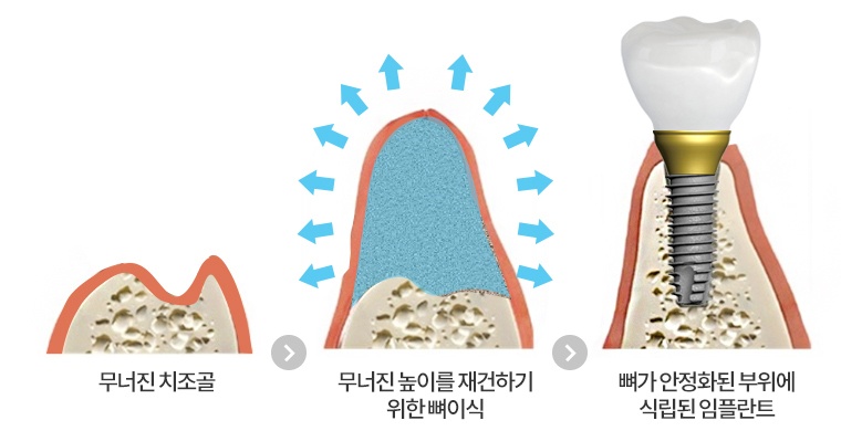 잇몸뼈의 높이가 부족한 경우: 부족한 뼈를 보완하고 임플란트를 식립하는 개념도