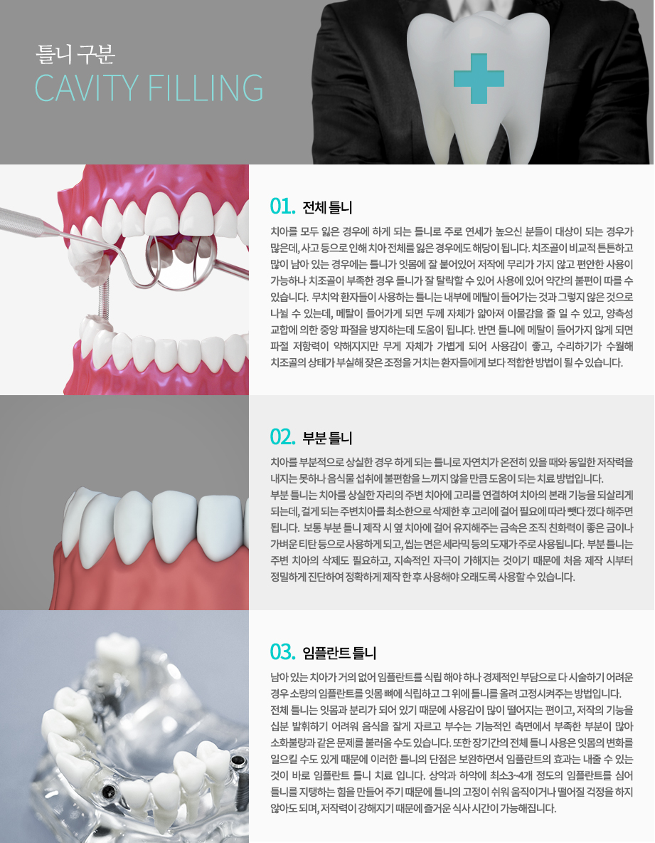 금속 구조와 연결 부품이 보이는 임플란트 보철 참고 사진