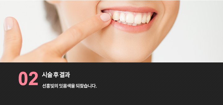 잇몸 색 개선을 설명하는 미소 참고 사진
