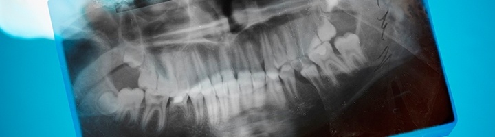 구강 진단을 설명하는 X-ray 이미지